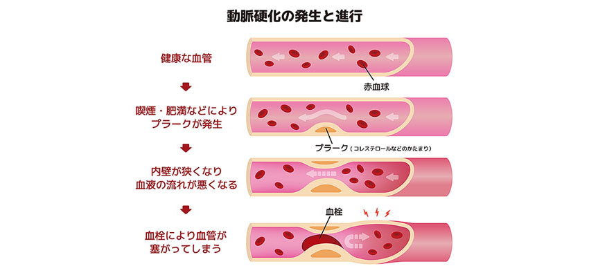 その冷え症、動脈硬化かもしれませんよ。