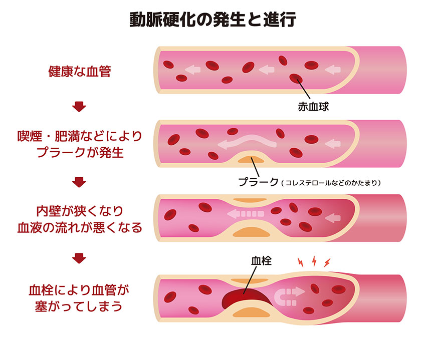 その冷え症、動脈硬化かもしれませんよ。